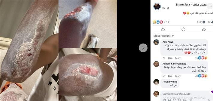 محطة مصر نيوز - عصام صاصا يكشف عن إصابته بجرح في يده ويطمئن جمهوره